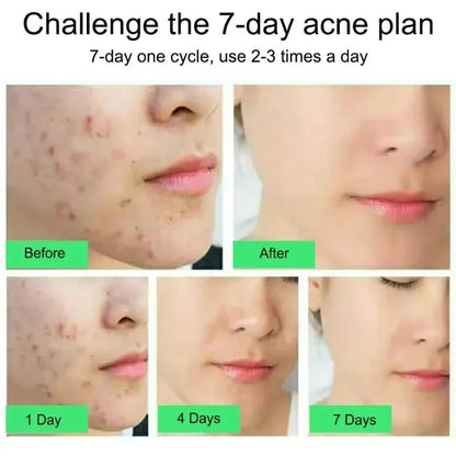 Salicylic Acid Acne Treatment Cream